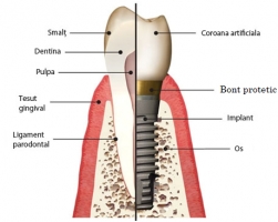 Implanturi dentare